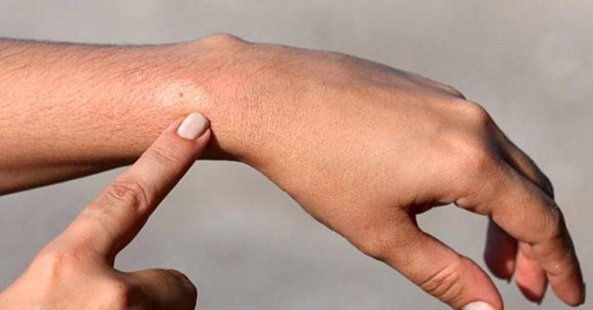 Arıların sokmalarına bağlı alerjik reaksiyonlar ölüme neden olabilir