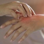 Egzama nedir? Egzama belirtileri, nedenleri ve etkili tedavi yöntemleri