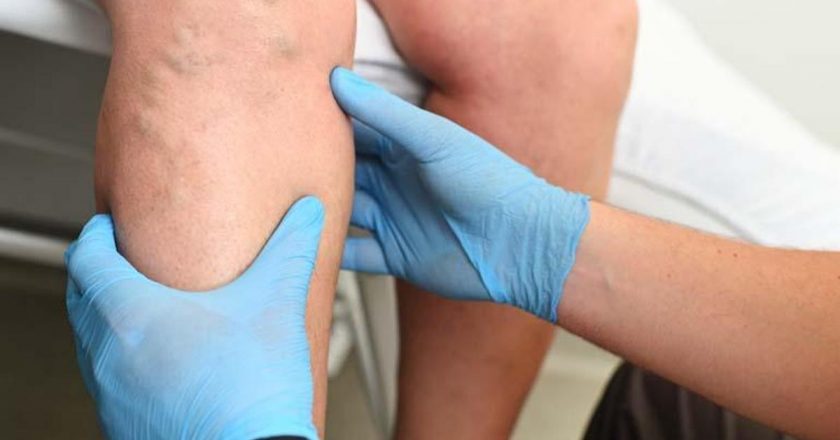 Hamilelik sırasında sola uzanma varisli damar riskini azaltır