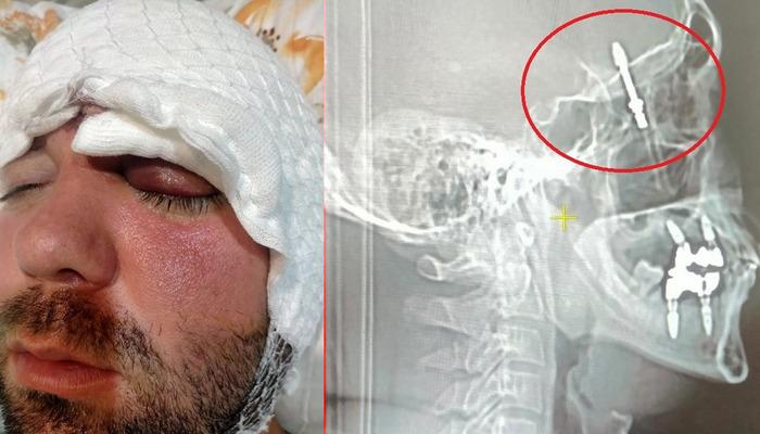 Bursa’da inanılmaz olay: Dişçiye gitti, hayatı kabusa döndü! Neredeyse ölüyordu