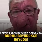 Burnu giderek büyüdü! 68 yaşındaki adam kabusunu yaşadı! 4 saat süren operasyonla adeta yeniden doğdu