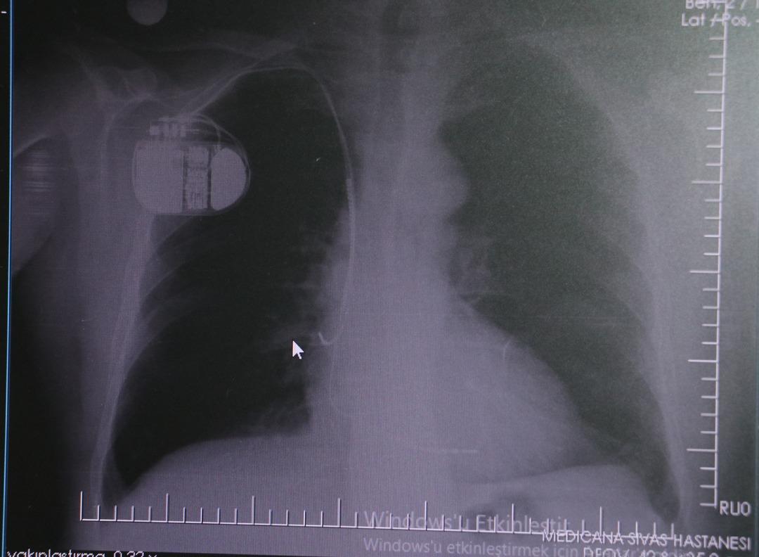 Kalp pili taşıyanlar dikkat! Soğuk hava uyarısı: