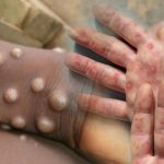 DSÖ M-pox Virüsü Uyarısı: Salgın kıtayı aştı! “Kontrol altında olmalı”