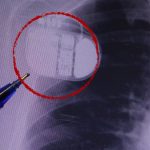 Kalp pili taşıyanlar dikkat! Soğuk Uyarısı: “Üşüme Cihazınızı Kandırabilir”