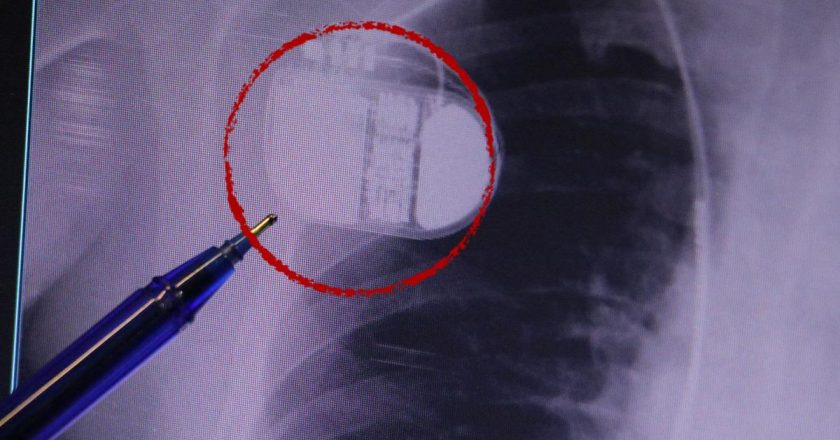 Kalp pili taşıyanlar dikkat! Soğuk Uyarısı: “Üşüme Cihazınızı Kandırabilir”