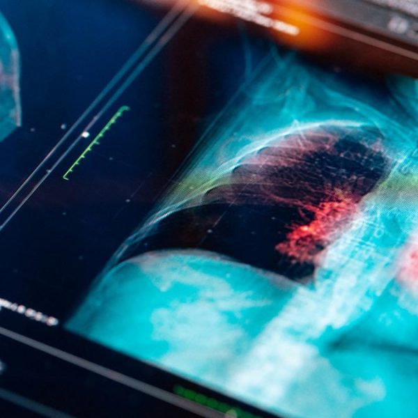 Türkiye’de her yıl 45 bin yeni vaka! Bu illerde dikkatli olun: Risk daha yüksek!