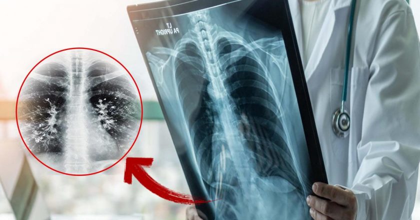 Gripten kurtuldunuz mu? Asıl tehlike şimdi başlıyor: “süper enfeksiyon” alarmı.